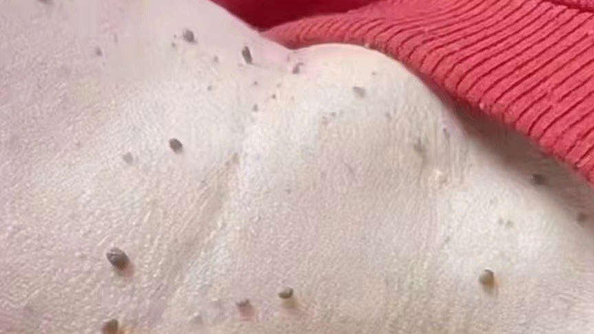 扁平疣的饮食方法